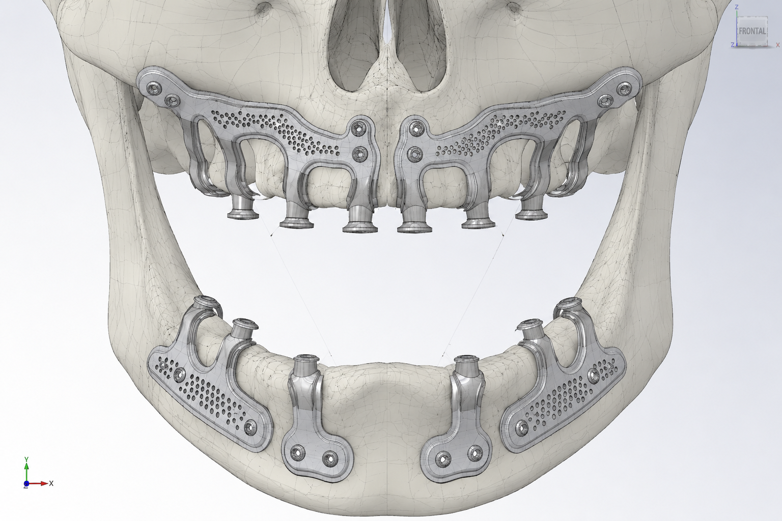 Planejamento digital 3D da malha de titânio para reconstrução maxilar sem enxerto ósseo